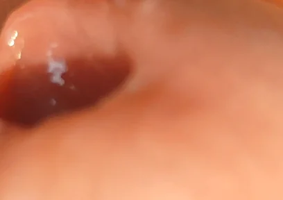 The Great Transformation of Phimosis Elastica.