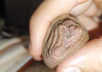 Silent Purge of Straight Scrotal Fluid.