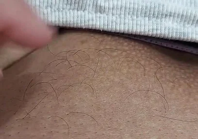The Hair on My Penis - Led Hair Removal