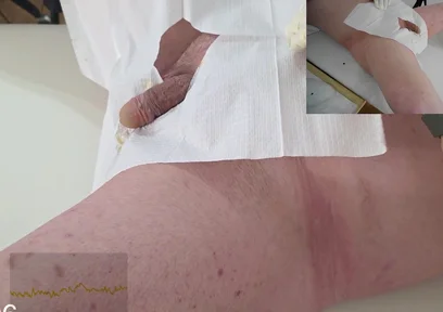 16 French Foley Insertion