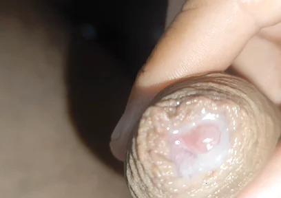 I Have the Largest Ejaculating Phimosis in the World!!