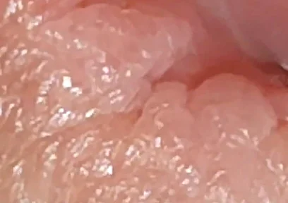 Enlargement of the Deep Urethral Hole!!