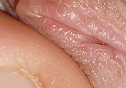 Enlargement of the Deep Urethral Hole!!