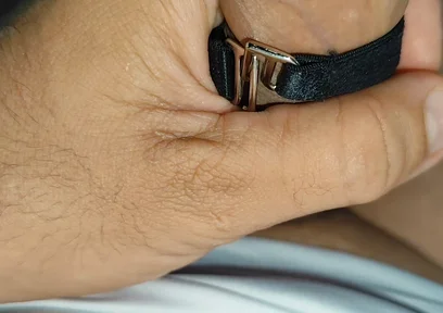 Electrical Pulsation Within the Glans with Rapid Excitation.