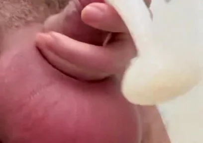 Inflated Ball Sack with Saline