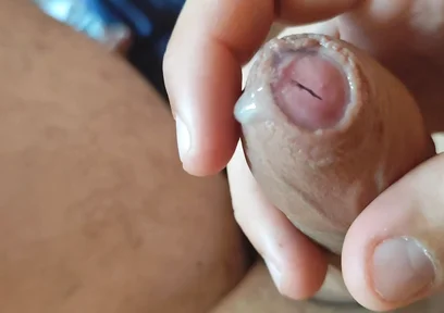 Dilation of the Corpus Cavernosum Exposes Spongy Foreskin.