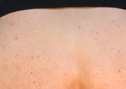 He Enjoys Sucking on His Anal Prolapse