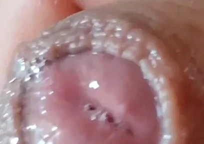 Deep Split in the Glans Produces Bubbling Liquid