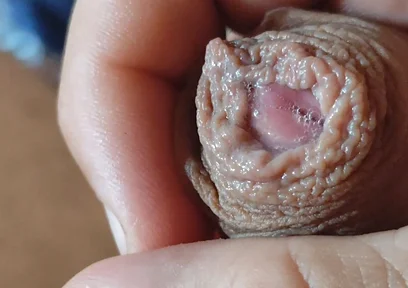 Deep Split in the Glans Produces Bubbling Liquid