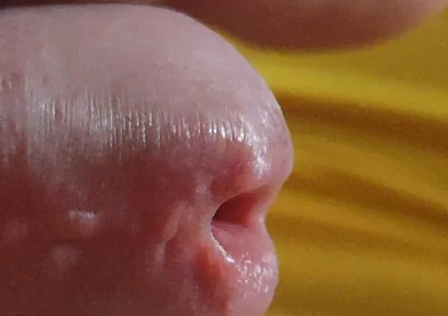 Scarred Frenulum Causes Glans Erection!