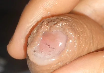 Curious Close-up of Pre-cum in Flaccid Phimosis.