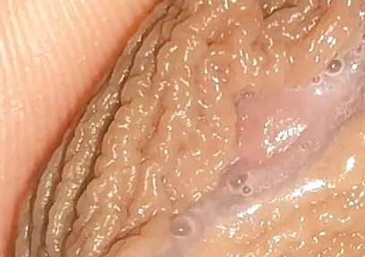 Curious Close-up of Pre-cum in Flaccid Phimosis.