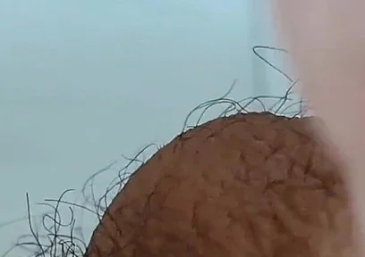 Extreme Open Hole Leaves the Glans Exposed.