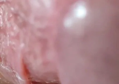 Opening the Scar of the Rough Frenulum!