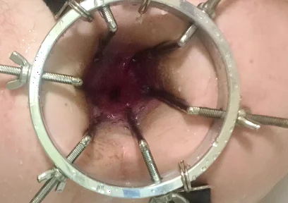 Enema, Anal Shower. Close-up View Through Anal Mirror. Anal with Water. Filling Anal with Water