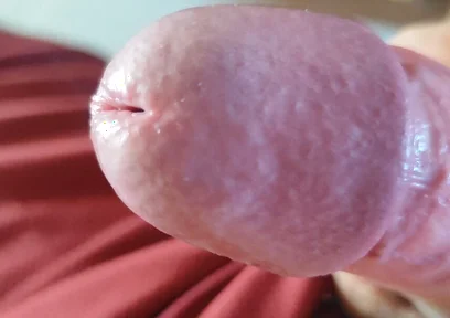 The Blossoming of Extensive Elastic Phimosis.