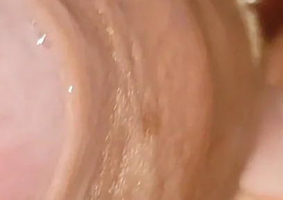 Large Cheese Accumulated in Close up of Glans