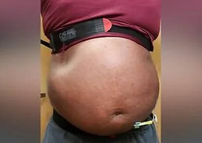 N2o Belly Inflation