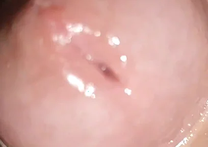 Maximum Dilation of Phimosis Cumming.
