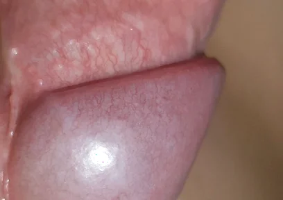 Amazing Upright Rough Venous Frenulum