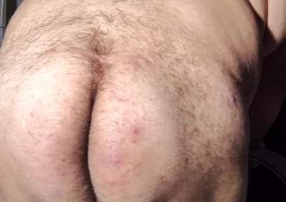 Fat Obese Butt