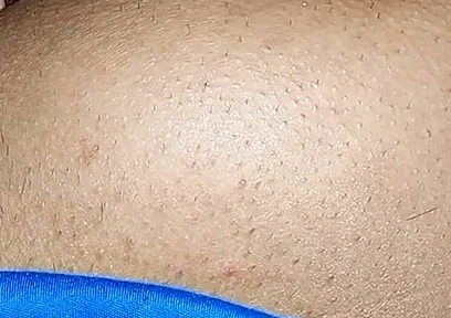 Hemorrhoids in the Ass