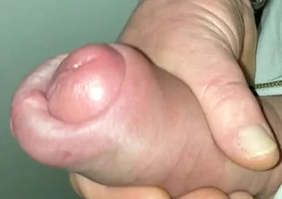 Huge Cock Pumped Foreskin Jerk off