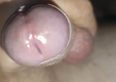 Scrotal Phimosis Results in an Extremely Hot Orgasm.