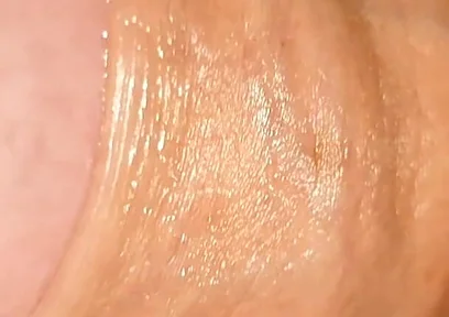Difficult Fluid Control Due to Straight Phimosis.