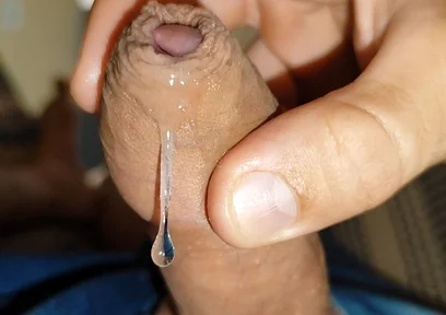 Difficult Fluid Control Due to Straight Phimosis