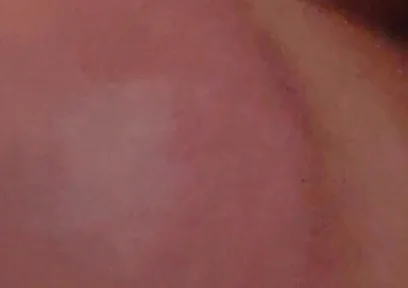 Immense Phimosis Being Extracted Cum and Précum.