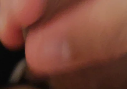 Immense Phimosis Being Extracted Cum and Précum.